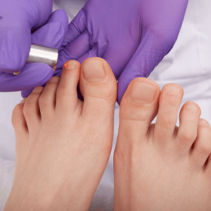 Laser For Toenail Fungus