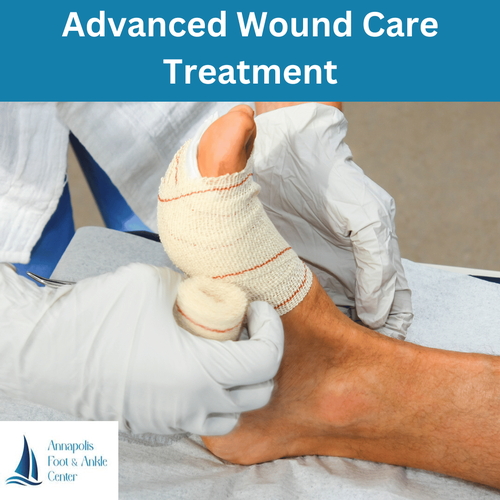 Foot Wound Treatment With Our Maryland Wound Specialist
